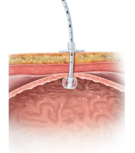 cross section illustration of balloon g tube against stomach wall